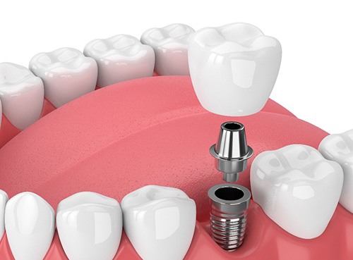 A CGI of a dental implant parts