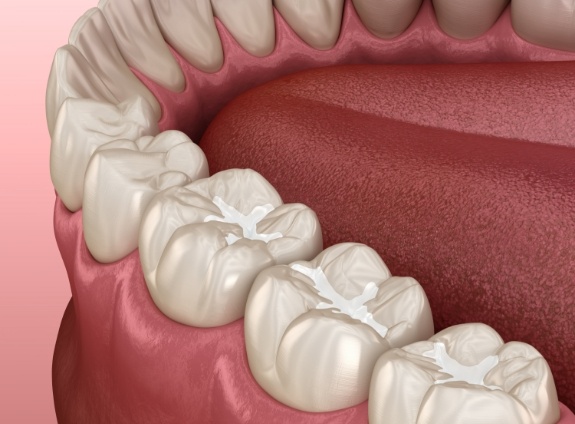 Illustrated row of teeth with dental sealants