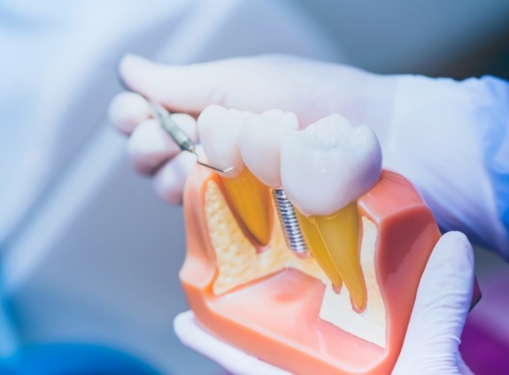 Dentist holding a model of a dental implant