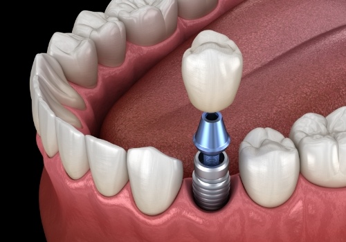 Illustrated dental crown being placed onto a dental implant