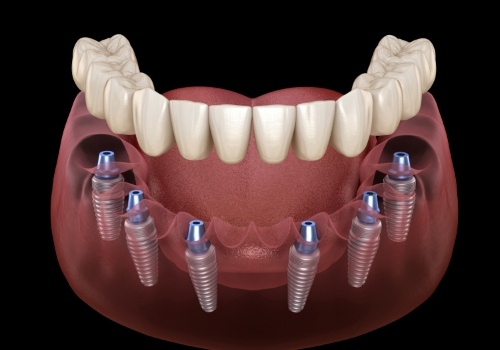 Illustrated full denture being placed onto six dental implants