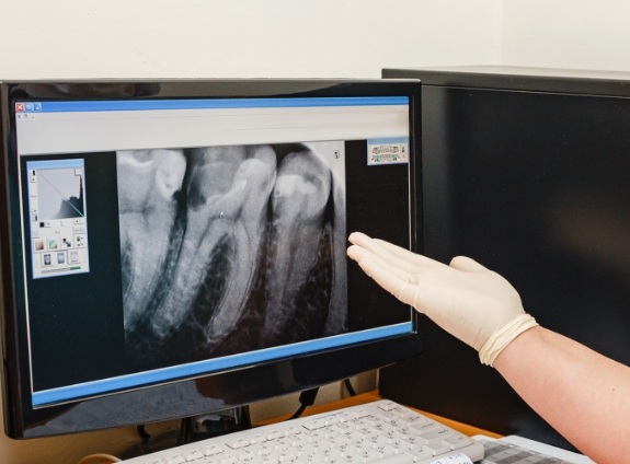 Dentist gesturing to computer screen showing digital x rays of teeth