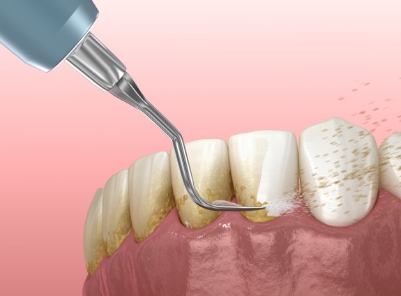 Illustrated dental instrument clearing plaque from teeth during gum disease treatment