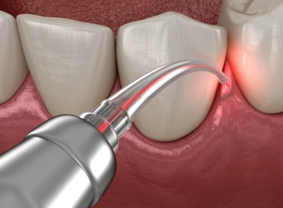 Illustrated dental laser treating gum disease