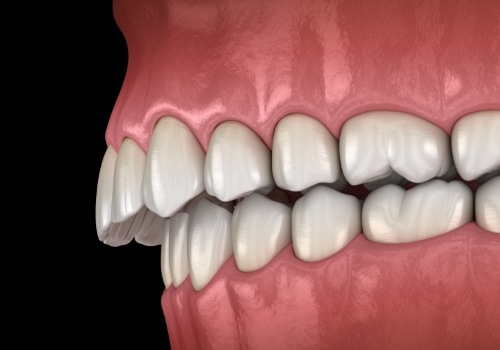 Illustrated mouth with overbite