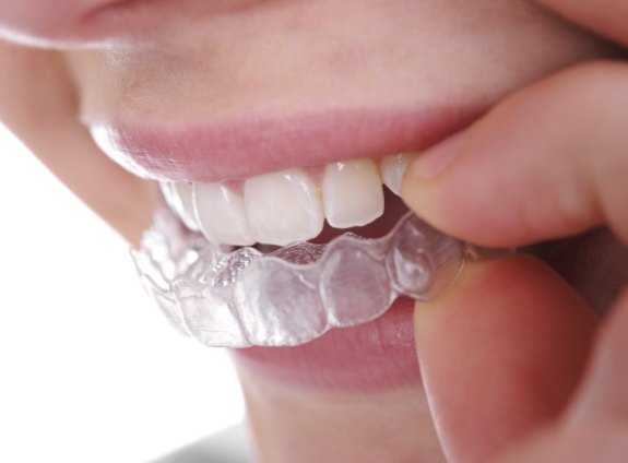 Close up of person placing Invisalign tray over their teeth