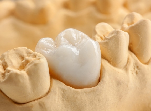 Dental crown over a tooth in a model of the mouth