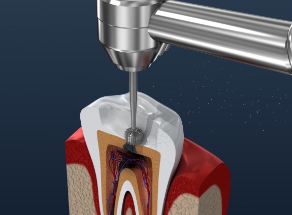 Illustrated dental instrument cleaning inside a tooth during root canal treatment