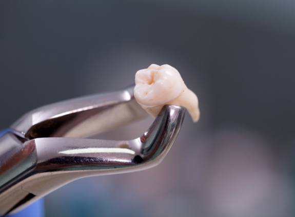 Dental forceps holding an extracted tooth