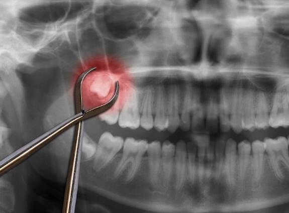 Dental forceps in front of X ray of teeth with impacted wisdom tooth highlighted red