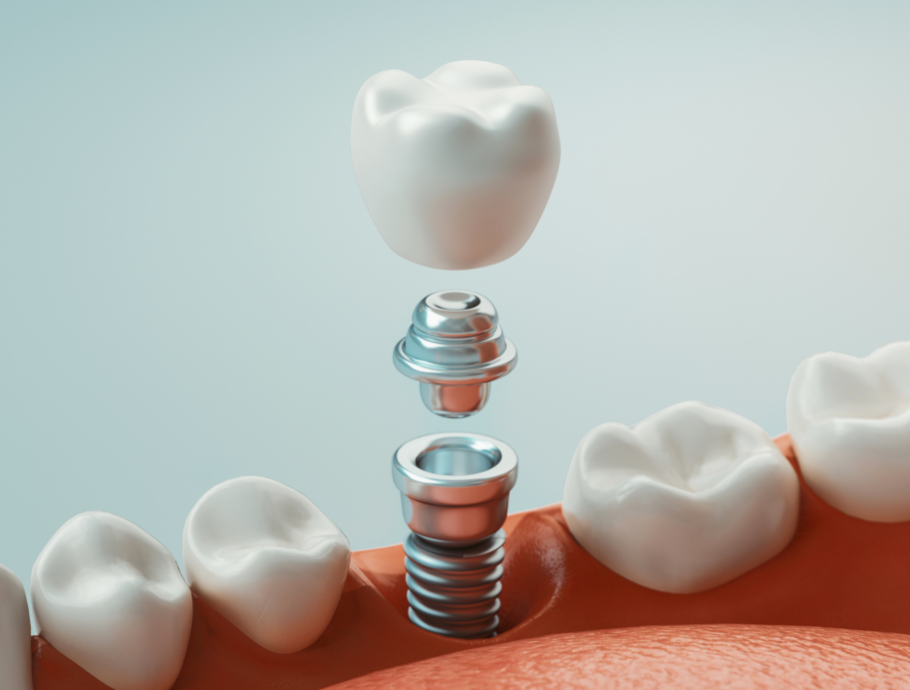 3D image of a dental implant